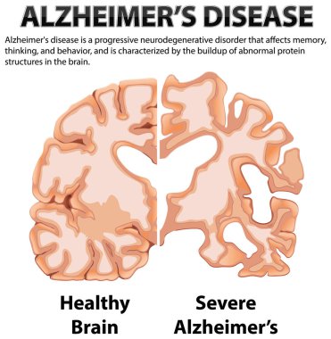 Alzheimer Hastalığı illüstrasyonunun bilgilendirici posteri