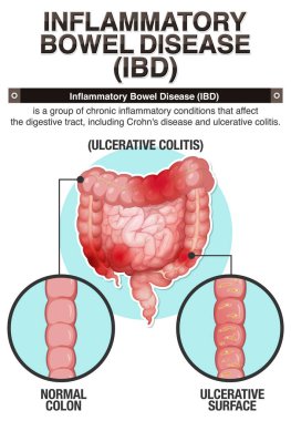 İltihaplı Bağırsak Hastalığı (IBD) Infographic Illustration
