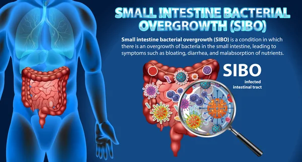 Иллюстрация Sibo Small Intestine Bacterial Overgrowth — стоковый вектор