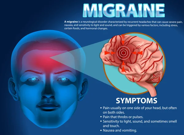 Affiche Informative Illustration Migraine — Image vectorielle