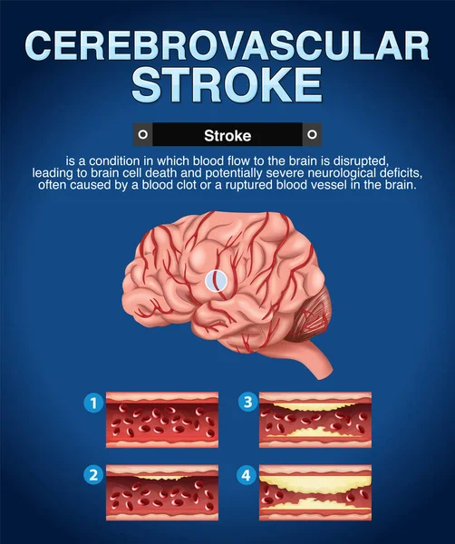 Cartel Informativo Ilustración Ictus Cerebrovascular — Vector de stock