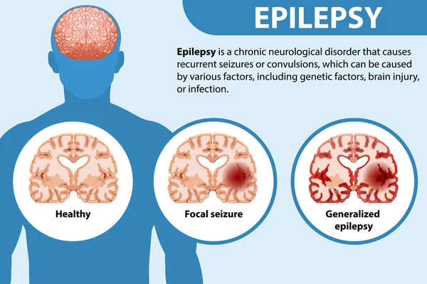 Cartaz Informativo Ilustração Epilepsia — Vetor de Stock