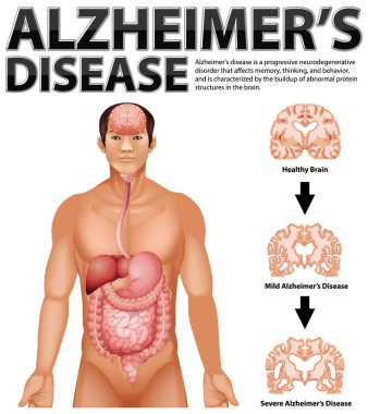 Alzheimer Hastalığı illüstrasyonunun bilgilendirici posteri