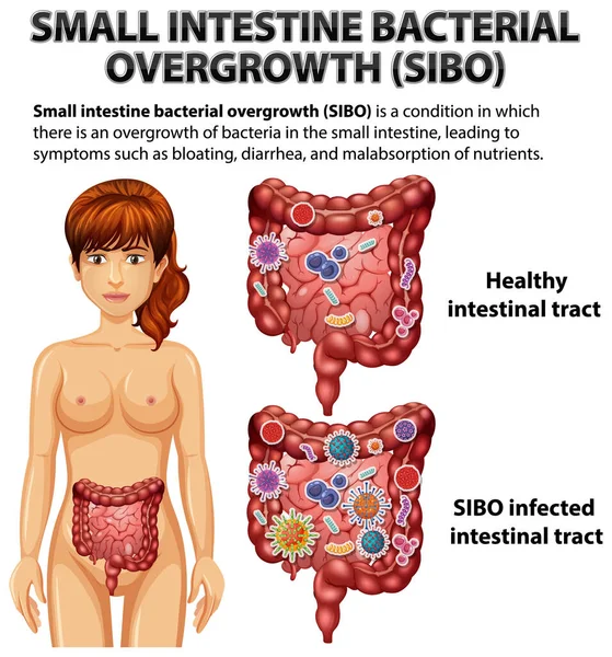 Kis Gyomor Baktériumok Elszaporodása Sibo Illusztráció — Stock Vector