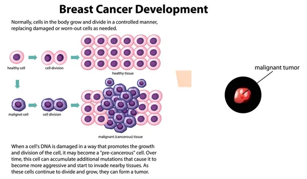 Cancer Vecteur Développement Avec Illustration Information — Image vectorielle