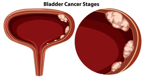 膀胱がんの病期ベクトル図 — ストックベクタ