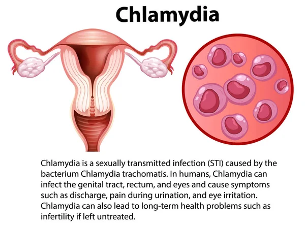 Klamydia Trachomatis Med Förklaring Illustration — Stock vektor