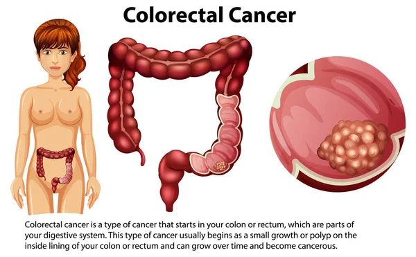 Colorectal Cancer Explanation Illustration — Stock Vector