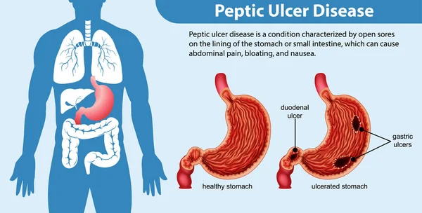 Ilustração Infográfica Doença Úlcera Péptica — Vetor de Stock