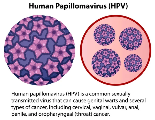 Human Papillomavirus Explanation Illustration - Stok Vektor