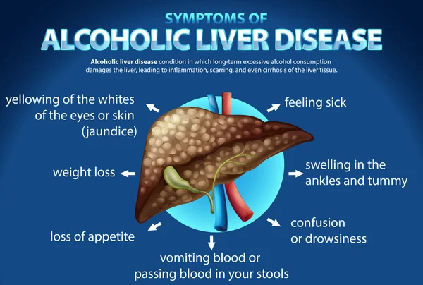 アルコール性肝疾患のインフォマティブポスター肝硬変イラスト — ストックベクタ