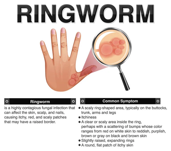 Informative Symptoms Ringworm Illustration — Stock Vector
