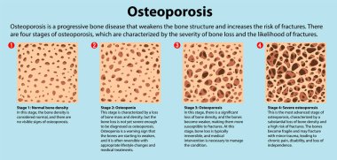Kemik Yoğunluğu ve Osteoporoz Vektör İllüstrasyonu