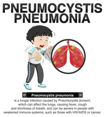 Pneumocystis pnömoni illüstrasyonunun bilgilendirici posteri