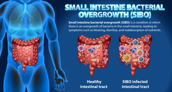 Kleine Darmbacteriële Overgroei Sibo Illustratie — Stockvector
