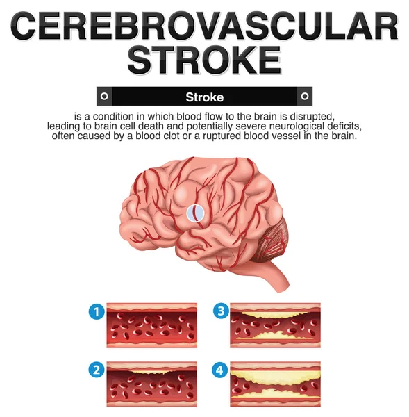 Informativ Affisch Cerebrovascular Stroke Illustration — Stock vektor