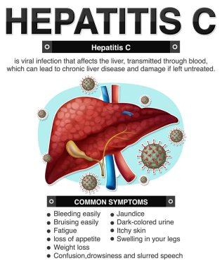 Hepatit C Infographic illüstrasyonunun belirtileri