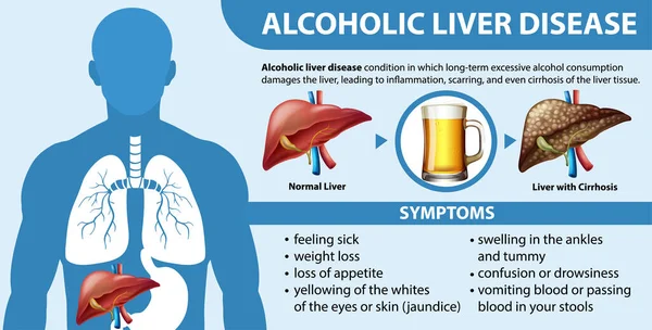 Manifesto Informativo Malattia Epatica Alcolica Illustrazione Cirrosi — Vettoriale Stock