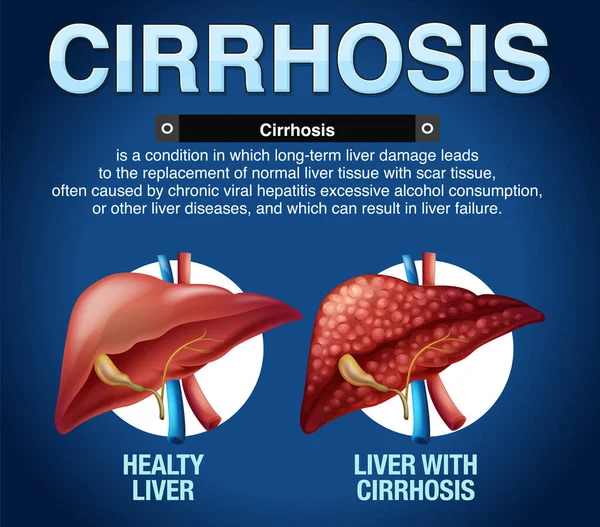 Cirrosis Del Hígado Ilustración Infográfica — Vector de stock