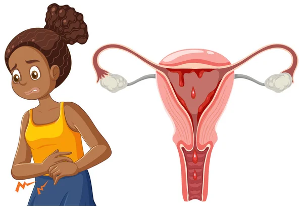 Africká Americká Dívka Zkušenosti Menstruační Křeče Během Puberty Ilustrace — Stockový vektor