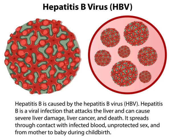 Vírus Hepatite Hbv Com Ilustração Explicativa — Vetor de Stock