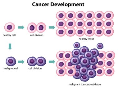 Cancer Development vector with information illustration clipart
