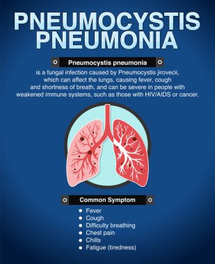 Pneumocystis pnömoni illüstrasyonunun bilgilendirici posteri