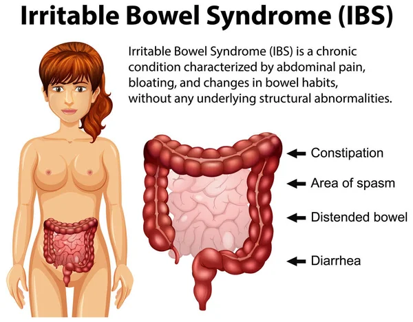 Irritable Bowel Syndrome Ibs Ilustrasi Infografis - Stok Vektor