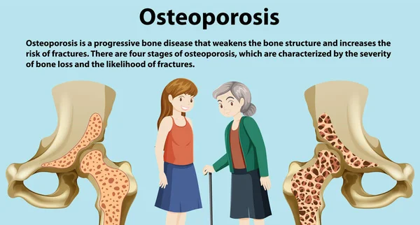 Densità Ossea Osteoporosi Illustrazione Vettoriale — Vettoriale Stock