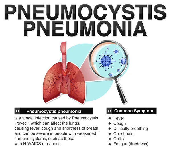 Affiche Informative Pneumocystis Pneumonie Illustration — Image vectorielle
