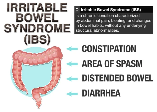Syndrome Côlon Irritable Sii Illustration Infographique — Image vectorielle