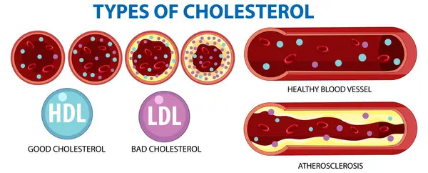 Illustration Hdl Ldl Atherosclerosis Blood Vessels Stockvector