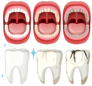 Sağlıklı ve çürük diş aşamalarını gösteren bir resim.