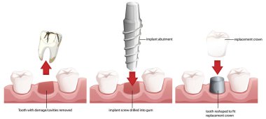 Diş implantı sürecinin adım adım rehberi