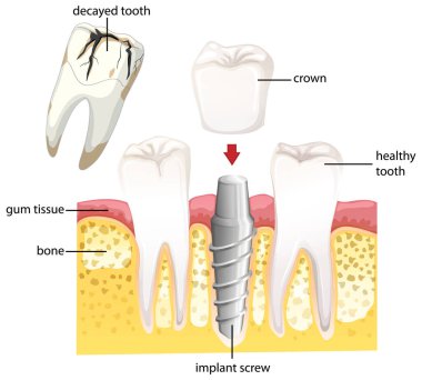 Diş implantı ve diş anatomisini gösteren diyagram