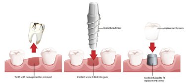 Diş implantı sürecinin adım adım rehberi