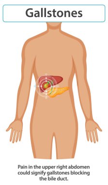 Illustration of gallstones affecting the human body clipart