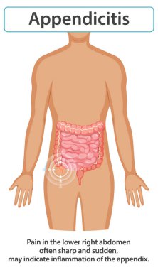 Apandisit konumu ve belirtileri gösteren diyagram