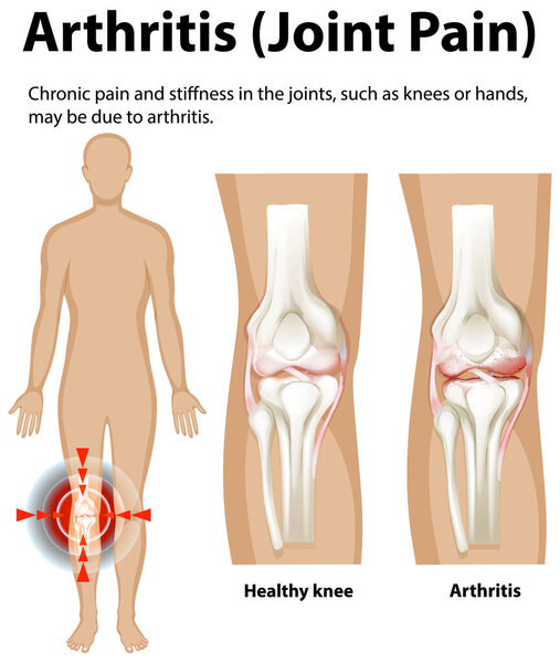 Illustration of arthritis affecting knee joints
