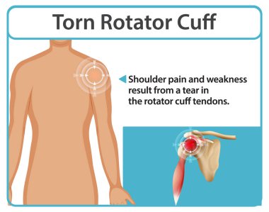 Omuz ağrısı ve tendon yırtılması.