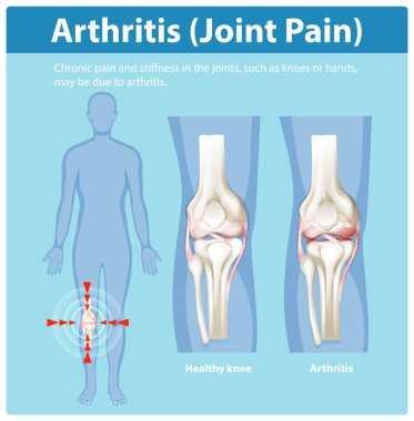 Sağlıklı ve artrit diz eklemleri.