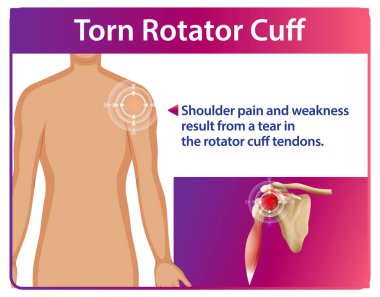 Omuz ağrısı ve tendon yırtılması.