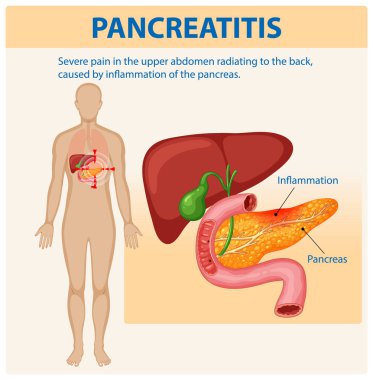 Pankreas iltihabı ve buna bağlı acı.