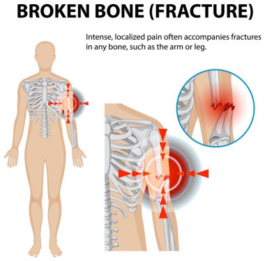 İnsan iskeletindeki kırık ağrısının göstergesi.