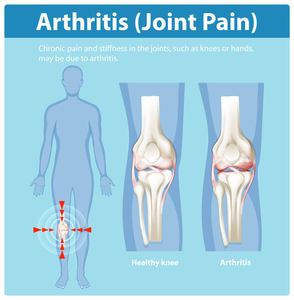 Illustration of healthy and arthritic knee joints