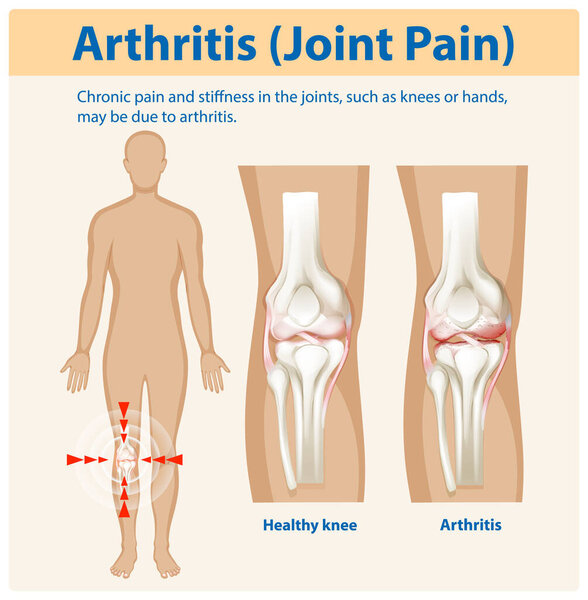 Illustration of arthritis affecting knee joints