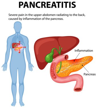 Pankreas iltihabı ve buna bağlı acı.