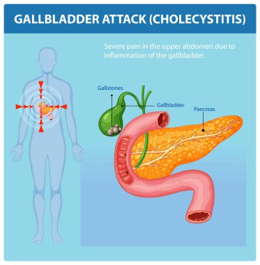 Illustration of gallbladder inflammation and related pain clipart