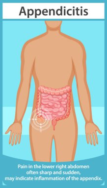 Apandisit belirtileri ve karın ağrısı.