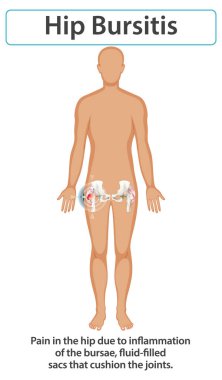 Illustration of hip bursitis and joint inflammation clipart